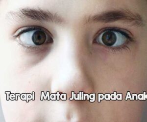 Terapi Mata Juling