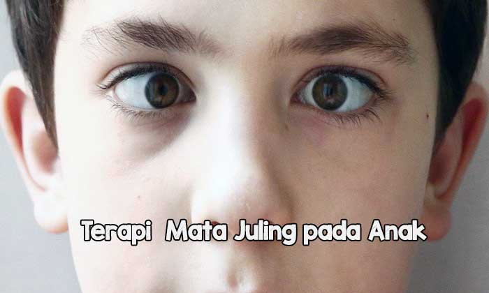 Terapi Mata Juling